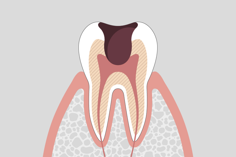 神経まで進行した虫歯